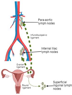 High-grade serous carcinoma of unknown primary origin associated with STIC clinically presented as isolated inguinal lymphadenopathy: a case report